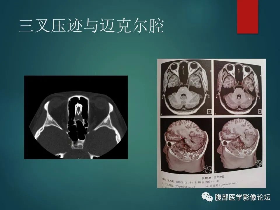 影像PPT - 【PPT】三叉孔道弯弯绕-25 影像PPT - 【PPT】三叉孔道弯弯绕-25