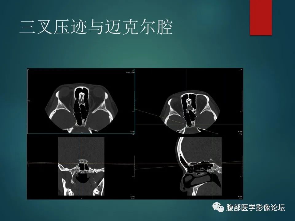 影像PPT - 【PPT】三叉孔道弯弯绕-26 影像PPT - 【PPT】三叉孔道弯弯绕-26
