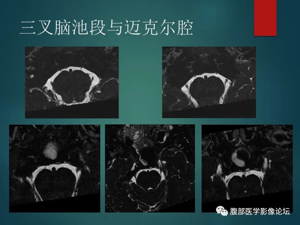 影像PPT - 【PPT】三叉孔道弯弯绕-28 影像PPT - 【PPT】三叉孔道弯弯绕-28