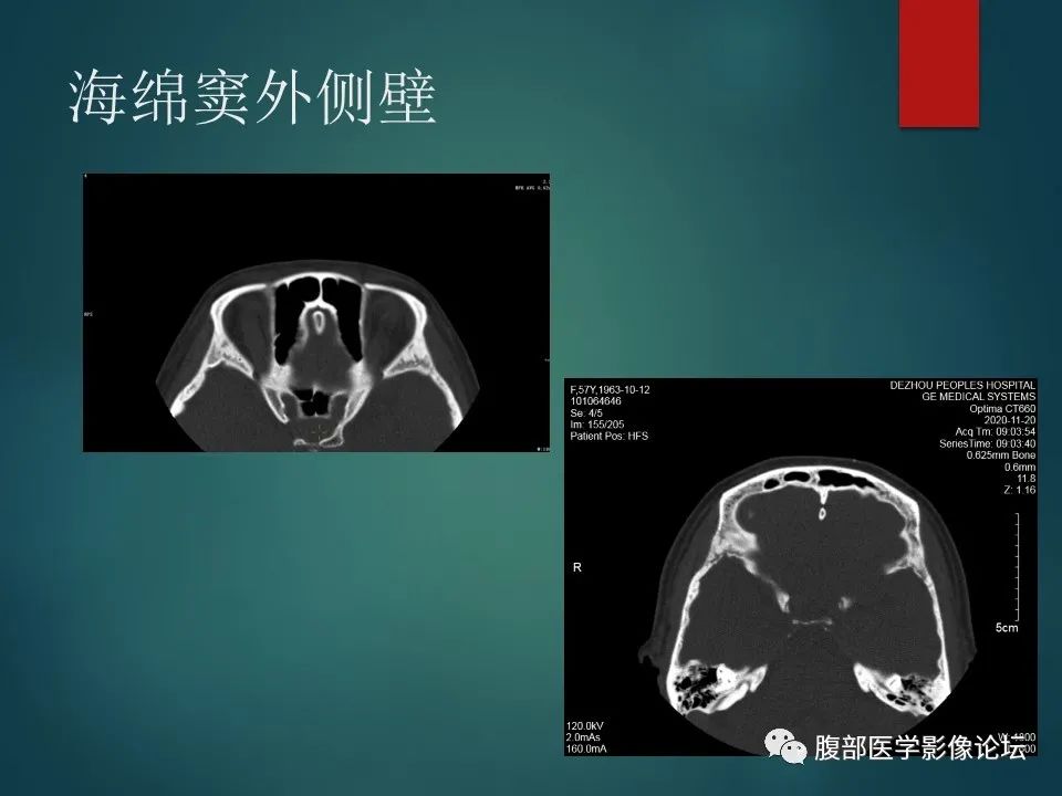 影像PPT - 【PPT】三叉孔道弯弯绕-29 影像PPT - 【PPT】三叉孔道弯弯绕-29