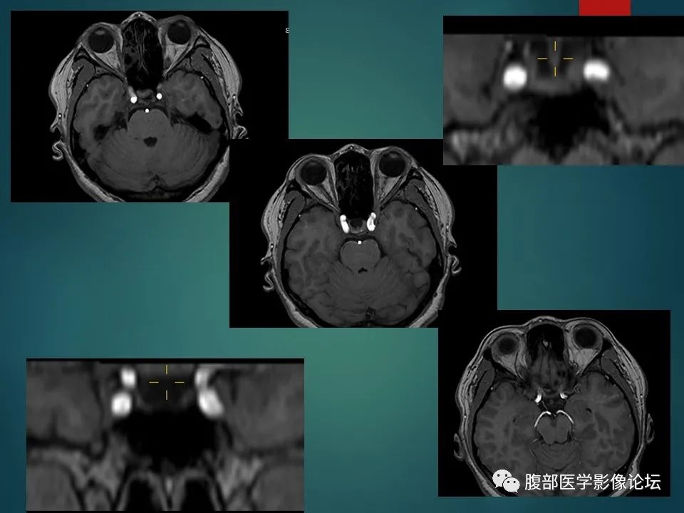 影像PPT - 【PPT】三叉孔道弯弯绕-30 影像PPT - 【PPT】三叉孔道弯弯绕-30