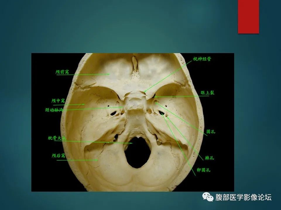 影像PPT - 【PPT】三叉孔道弯弯绕-31 影像PPT - 【PPT】三叉孔道弯弯绕-31