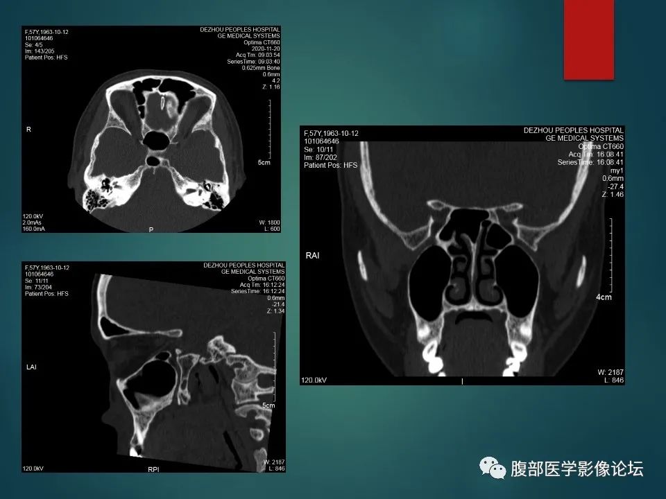 影像PPT - 【PPT】三叉孔道弯弯绕-32 影像PPT - 【PPT】三叉孔道弯弯绕-32