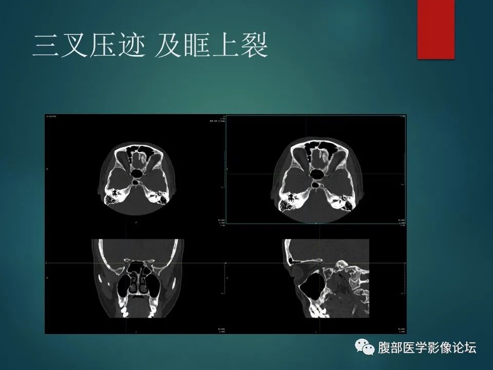 影像PPT - 【PPT】三叉孔道弯弯绕-33 影像PPT - 【PPT】三叉孔道弯弯绕-33