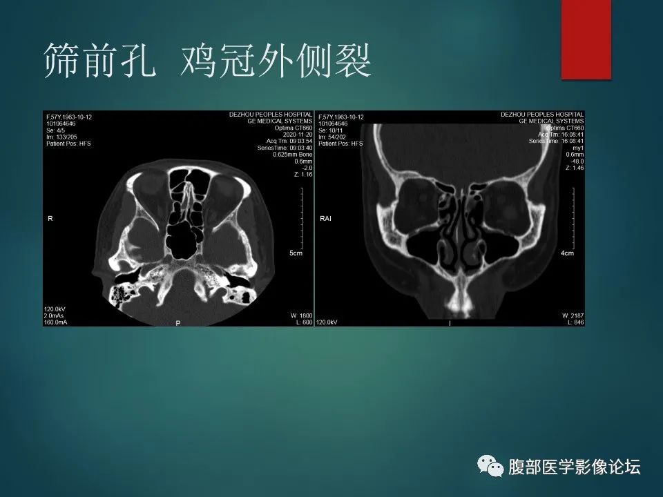 影像PPT - 【PPT】三叉孔道弯弯绕-34 影像PPT - 【PPT】三叉孔道弯弯绕-34