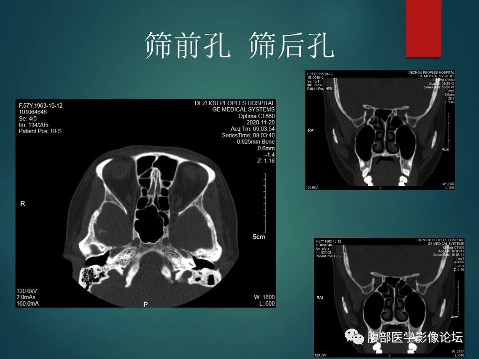 影像PPT - 【PPT】三叉孔道弯弯绕-35 影像PPT - 【PPT】三叉孔道弯弯绕-35
