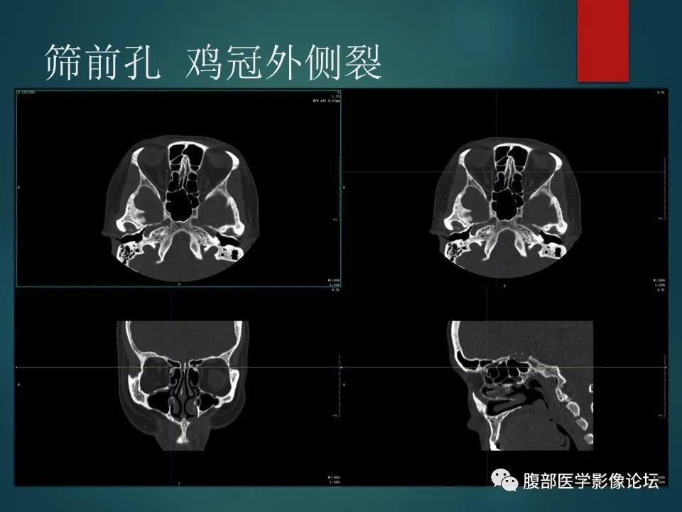 影像PPT - 【PPT】三叉孔道弯弯绕-36 影像PPT - 【PPT】三叉孔道弯弯绕-36