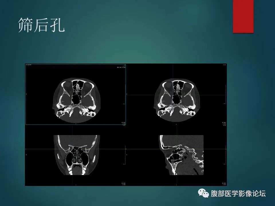 影像PPT - 【PPT】三叉孔道弯弯绕-37 影像PPT - 【PPT】三叉孔道弯弯绕-37
