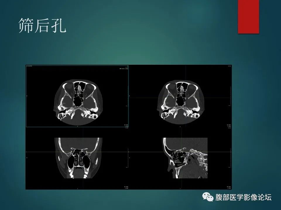 影像PPT - 【PPT】三叉孔道弯弯绕-38 影像PPT - 【PPT】三叉孔道弯弯绕-38