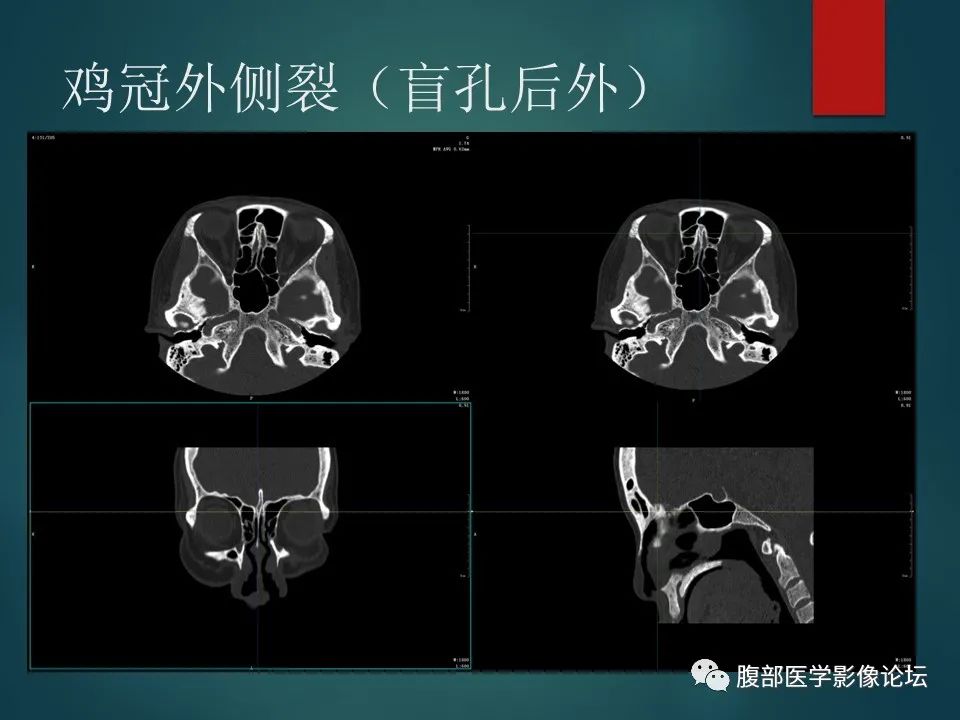 影像PPT - 【PPT】三叉孔道弯弯绕-39 影像PPT - 【PPT】三叉孔道弯弯绕-39