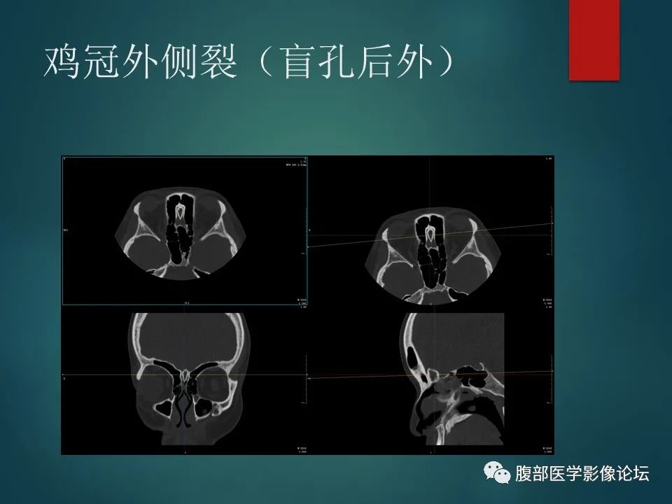 影像PPT - 【PPT】三叉孔道弯弯绕-40 影像PPT - 【PPT】三叉孔道弯弯绕-40