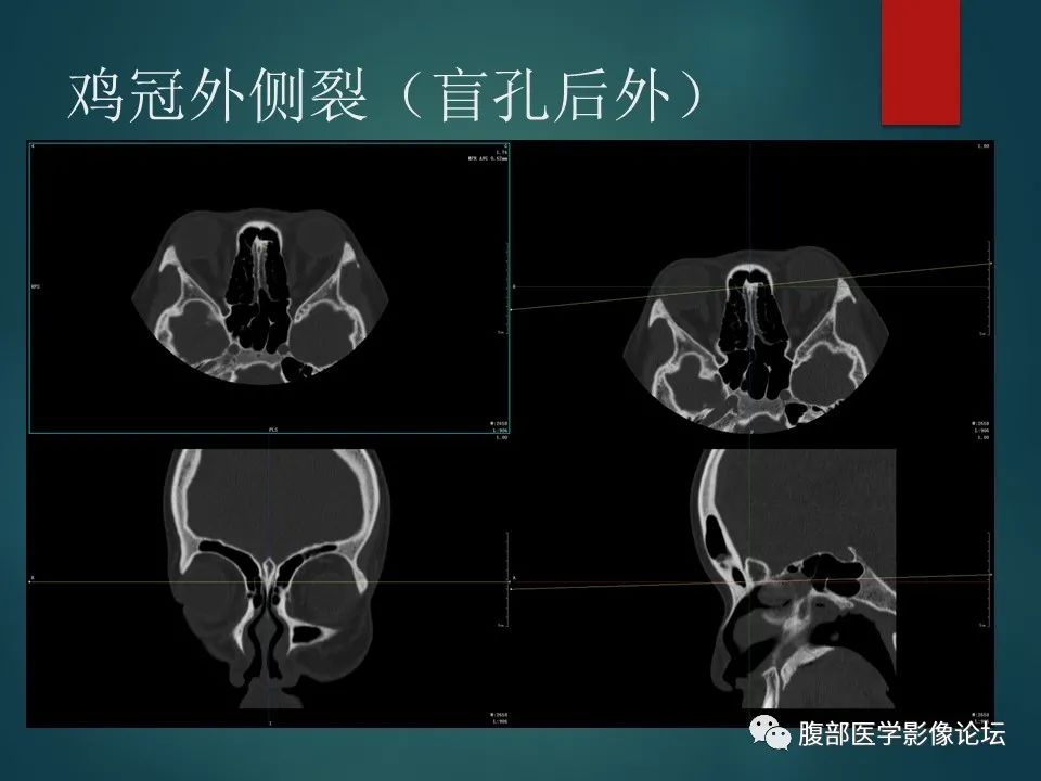 影像PPT - 【PPT】三叉孔道弯弯绕-41 影像PPT - 【PPT】三叉孔道弯弯绕-41