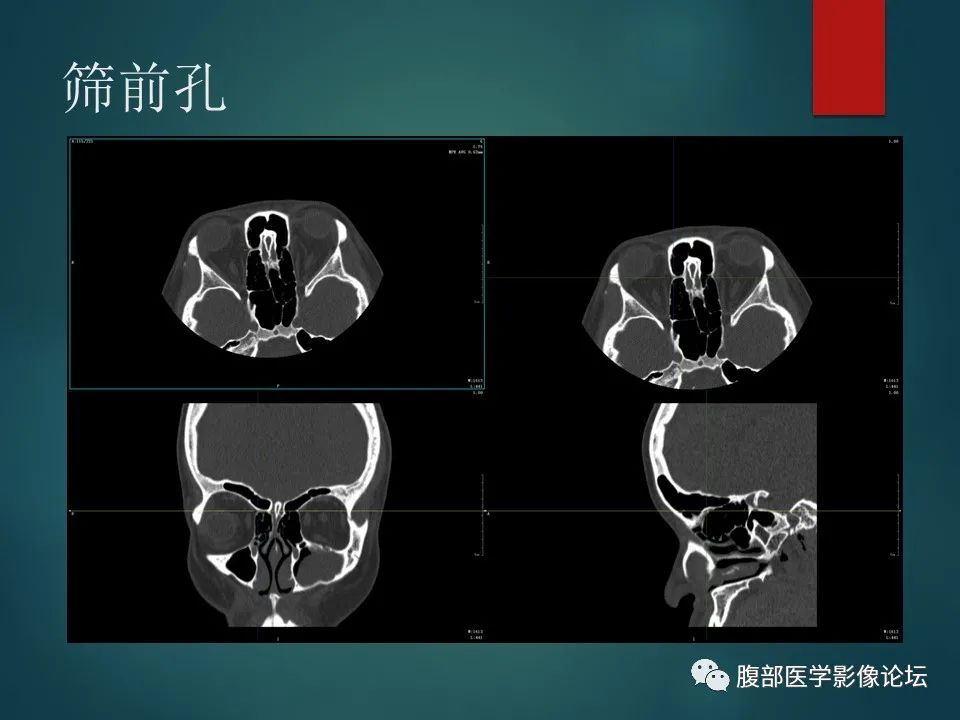 影像PPT - 【PPT】三叉孔道弯弯绕-42 影像PPT - 【PPT】三叉孔道弯弯绕-42