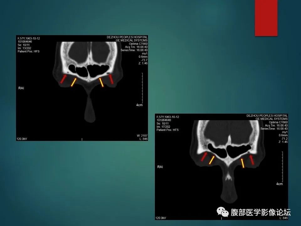 影像PPT - 【PPT】三叉孔道弯弯绕-45 影像PPT - 【PPT】三叉孔道弯弯绕-45