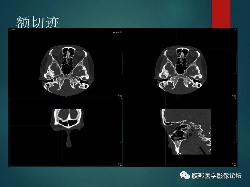 影像PPT - 【PPT】三叉孔道弯弯绕-46 影像PPT - 【PPT】三叉孔道弯弯绕-46