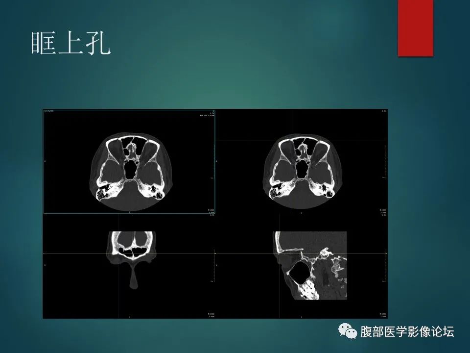 影像PPT - 【PPT】三叉孔道弯弯绕-47 影像PPT - 【PPT】三叉孔道弯弯绕-47