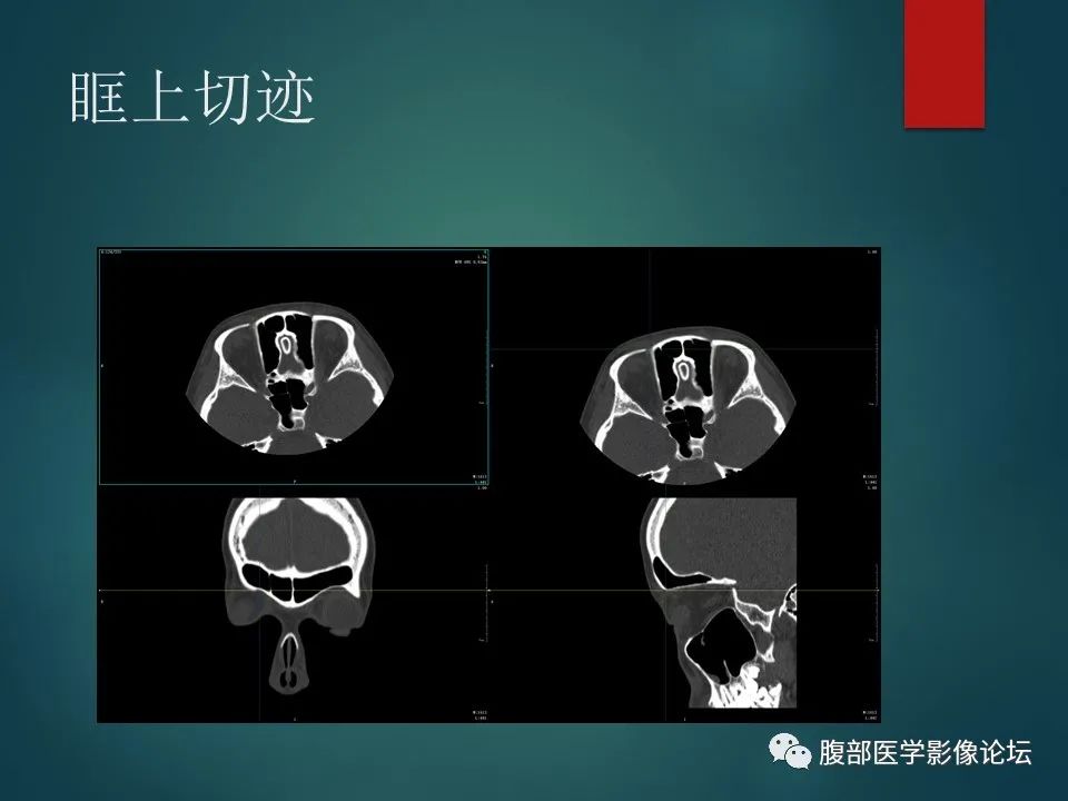 影像PPT - 【PPT】三叉孔道弯弯绕-48 影像PPT - 【PPT】三叉孔道弯弯绕-48