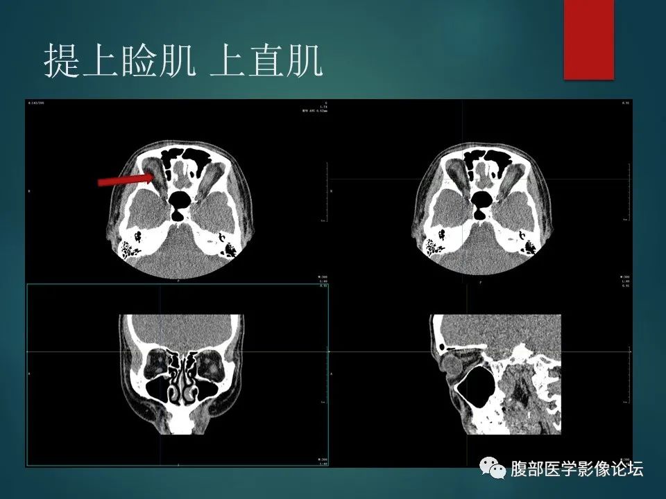 影像PPT - 【PPT】三叉孔道弯弯绕-49 影像PPT - 【PPT】三叉孔道弯弯绕-49