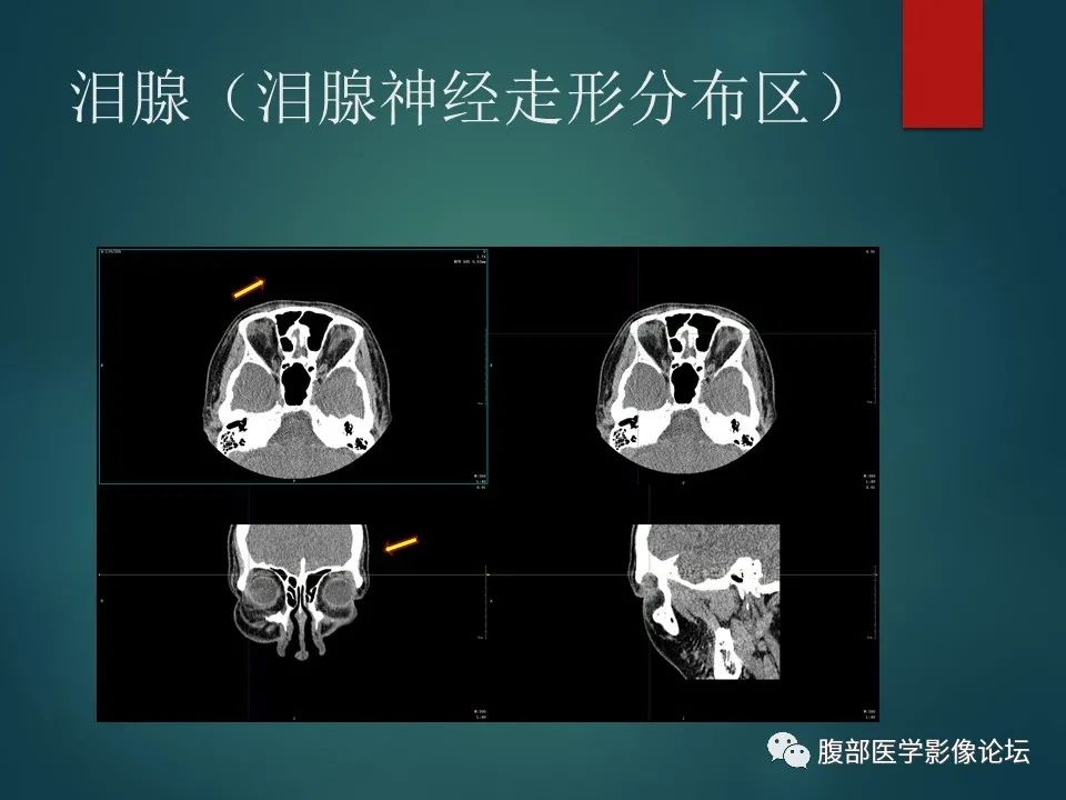 影像PPT - 【PPT】三叉孔道弯弯绕-50 影像PPT - 【PPT】三叉孔道弯弯绕-50