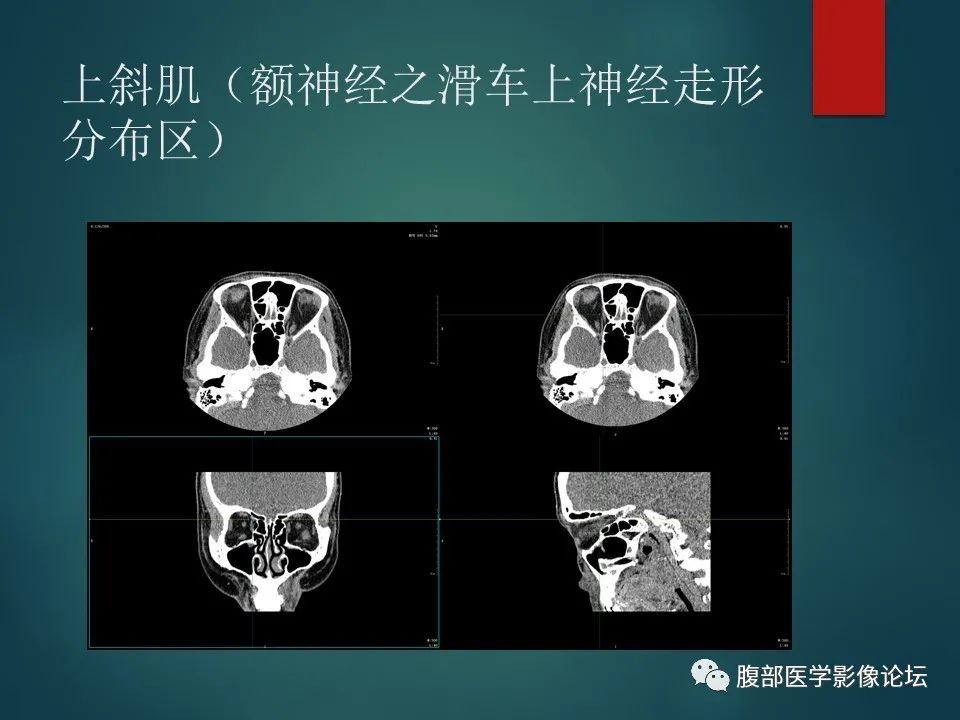 影像PPT - 【PPT】三叉孔道弯弯绕-51 影像PPT - 【PPT】三叉孔道弯弯绕-51