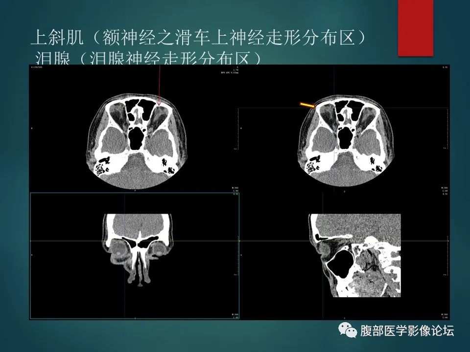 影像PPT - 【PPT】三叉孔道弯弯绕-52 影像PPT - 【PPT】三叉孔道弯弯绕-52
