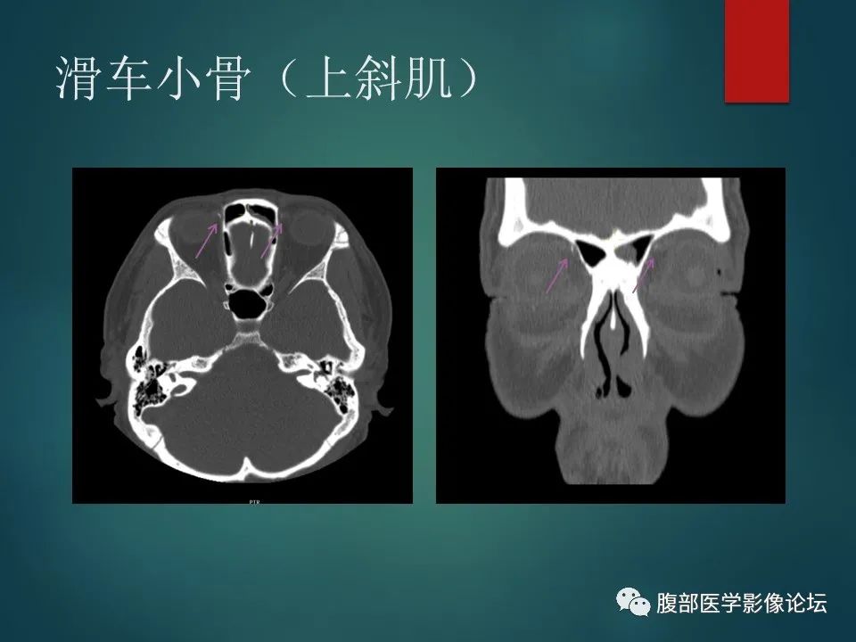 影像PPT - 【PPT】三叉孔道弯弯绕-53 影像PPT - 【PPT】三叉孔道弯弯绕-53