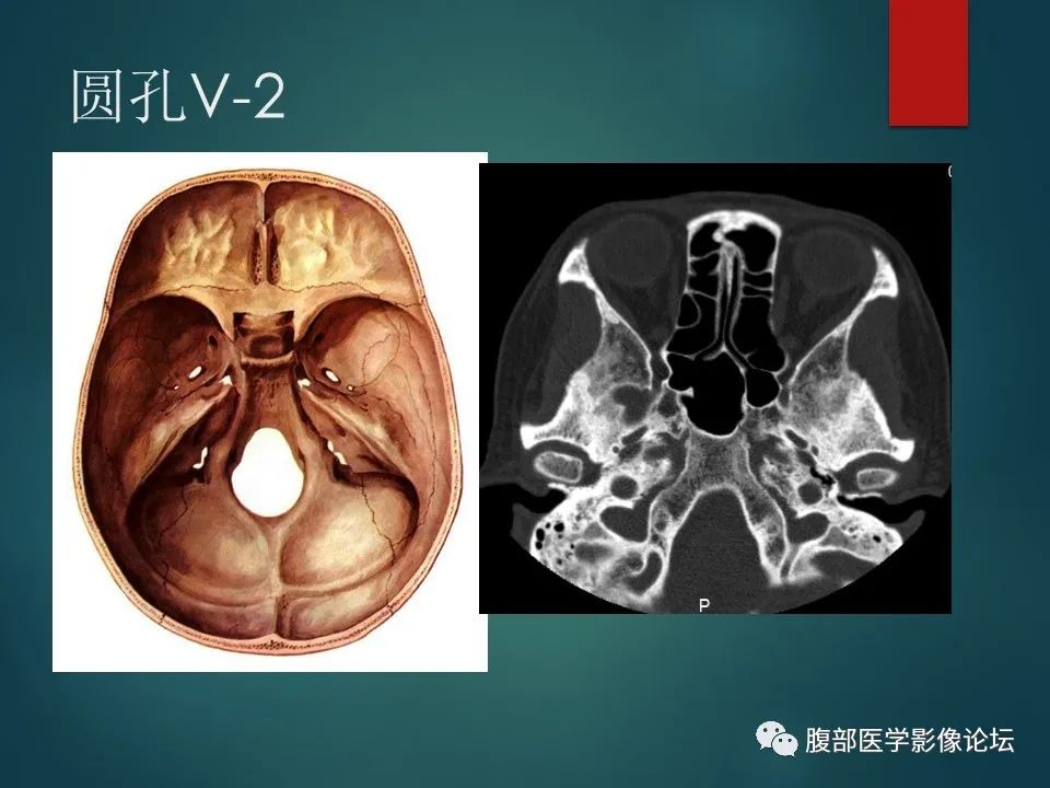 影像PPT - 【PPT】三叉孔道弯弯绕-54 影像PPT - 【PPT】三叉孔道弯弯绕-54