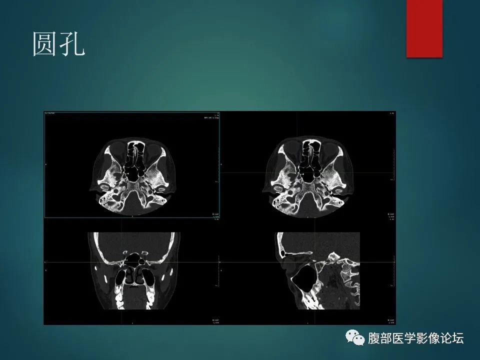 影像PPT - 【PPT】三叉孔道弯弯绕-56 影像PPT - 【PPT】三叉孔道弯弯绕-56