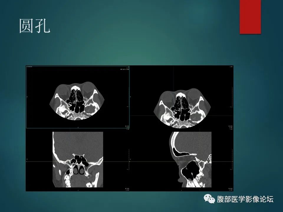 影像PPT - 【PPT】三叉孔道弯弯绕-57 影像PPT - 【PPT】三叉孔道弯弯绕-57