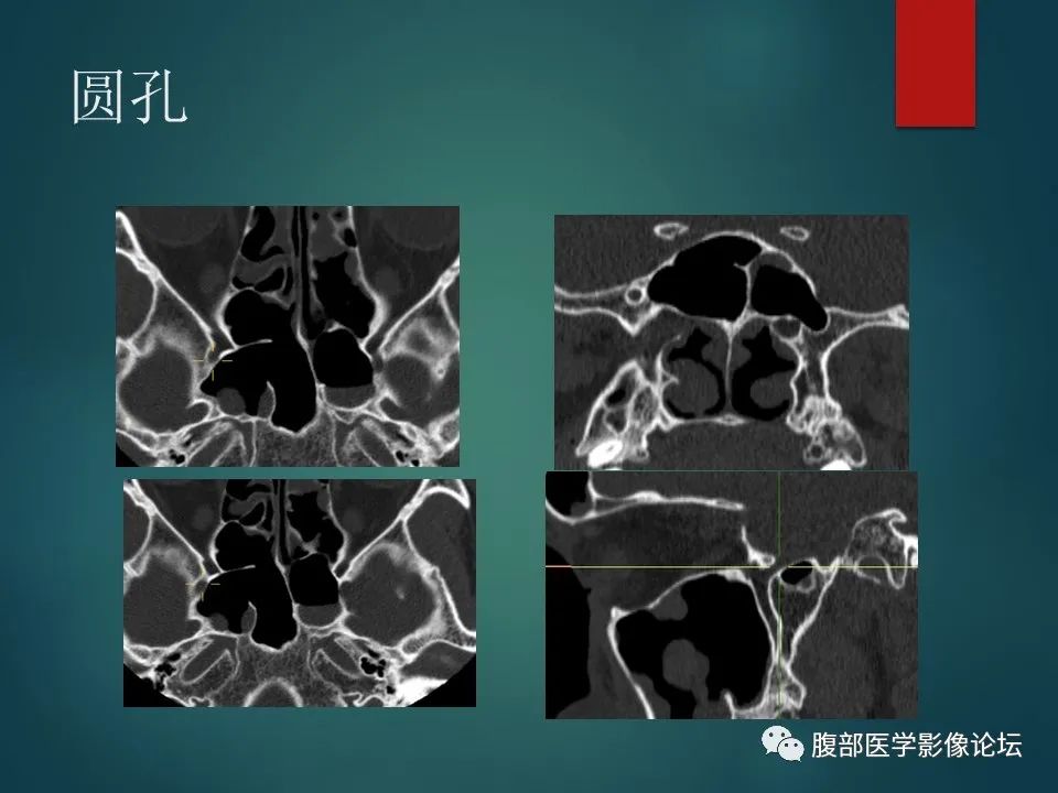 影像PPT - 【PPT】三叉孔道弯弯绕-58 影像PPT - 【PPT】三叉孔道弯弯绕-58