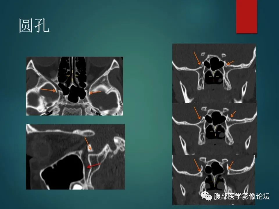 影像PPT - 【PPT】三叉孔道弯弯绕-59 影像PPT - 【PPT】三叉孔道弯弯绕-59