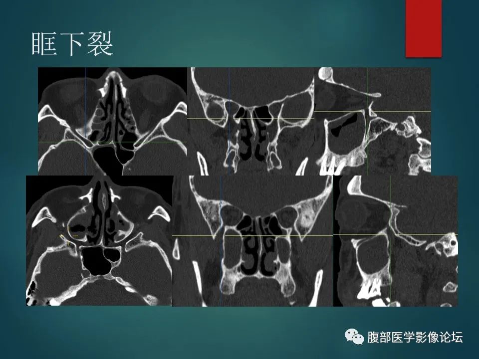 影像PPT - 【PPT】三叉孔道弯弯绕-61 影像PPT - 【PPT】三叉孔道弯弯绕-61