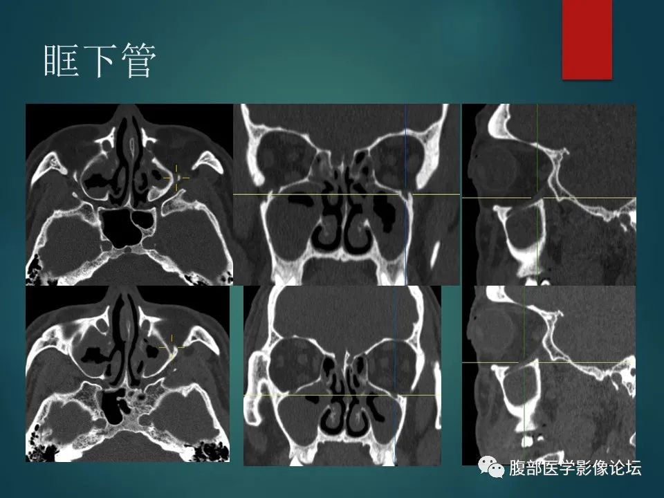 影像PPT - 【PPT】三叉孔道弯弯绕-62 影像PPT - 【PPT】三叉孔道弯弯绕-62