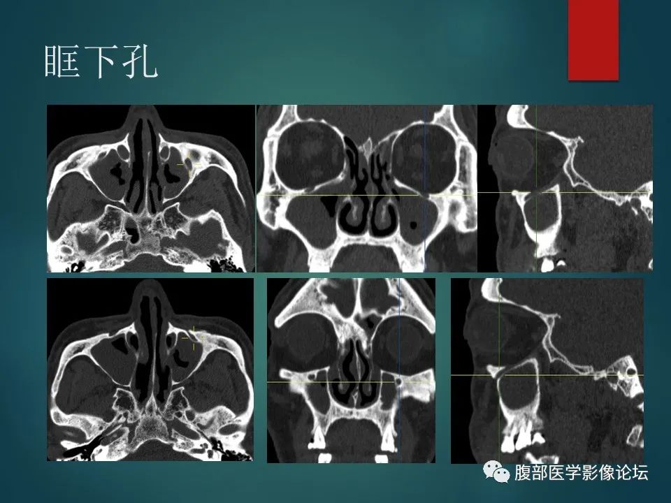 影像PPT - 【PPT】三叉孔道弯弯绕-63 影像PPT - 【PPT】三叉孔道弯弯绕-63