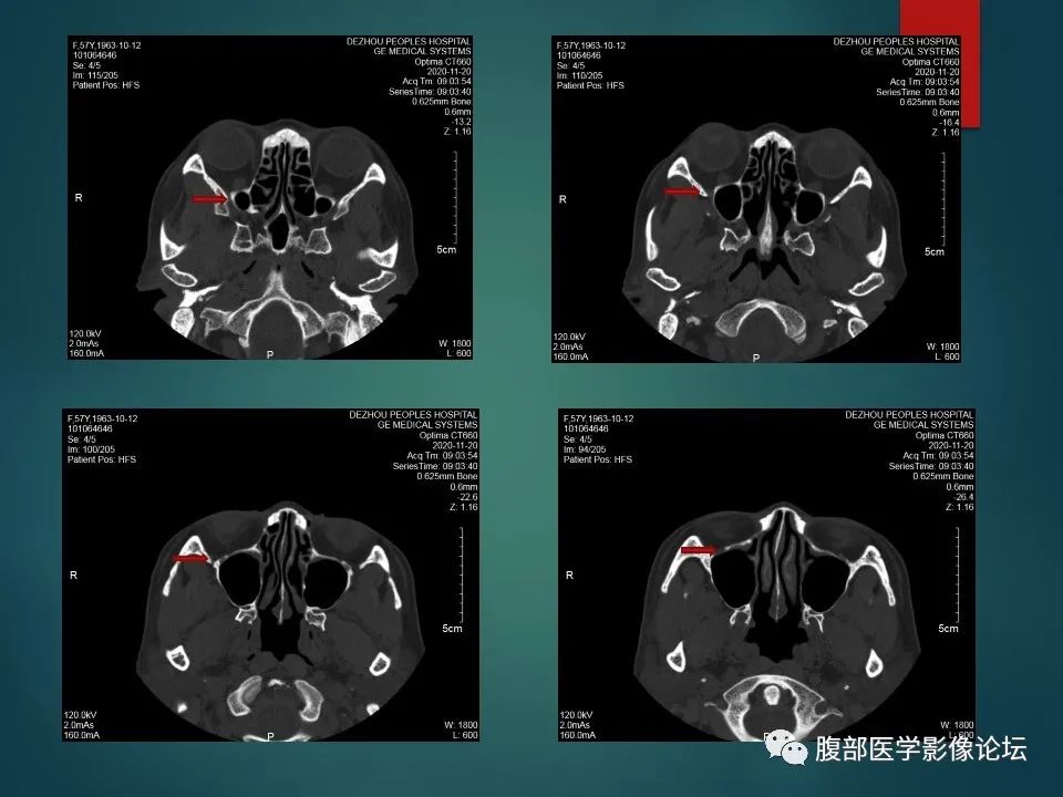 影像PPT - 【PPT】三叉孔道弯弯绕-64 影像PPT - 【PPT】三叉孔道弯弯绕-64