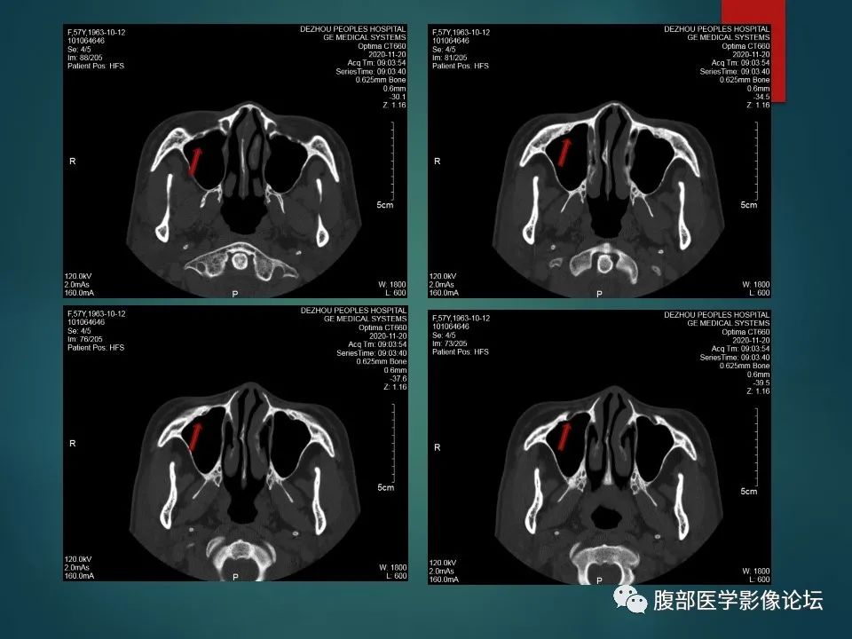 影像PPT - 【PPT】三叉孔道弯弯绕-65 影像PPT - 【PPT】三叉孔道弯弯绕-65