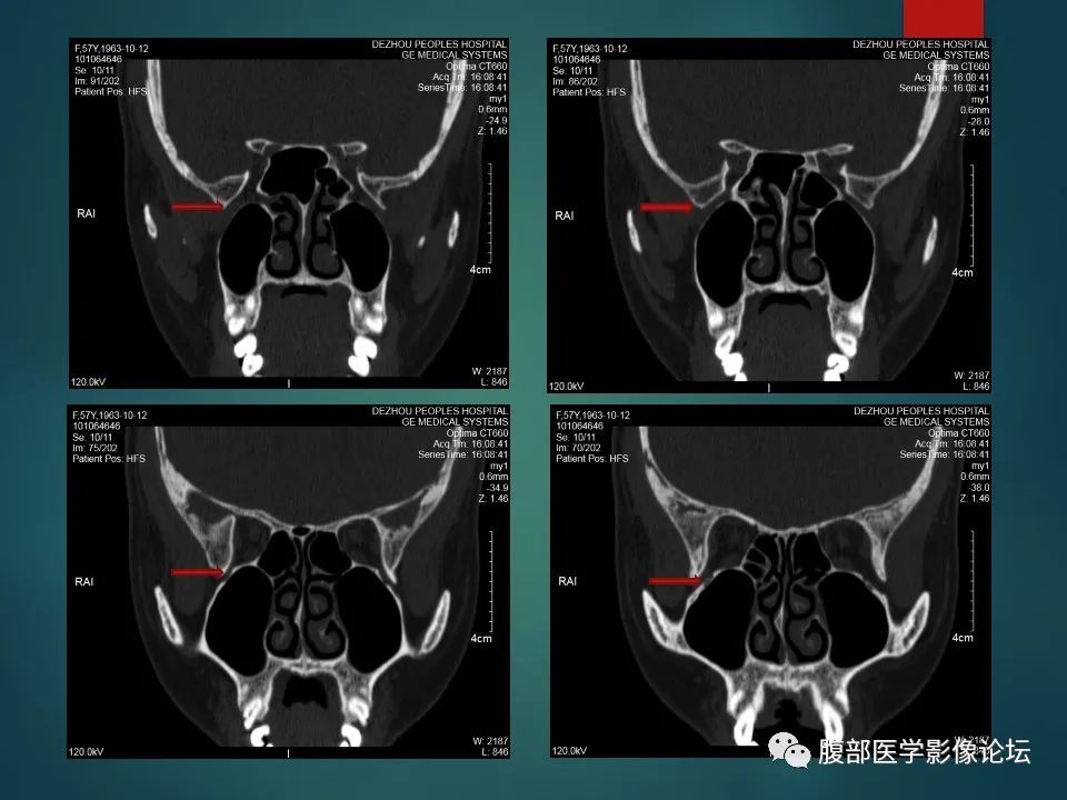 影像PPT - 【PPT】三叉孔道弯弯绕-66 影像PPT - 【PPT】三叉孔道弯弯绕-66