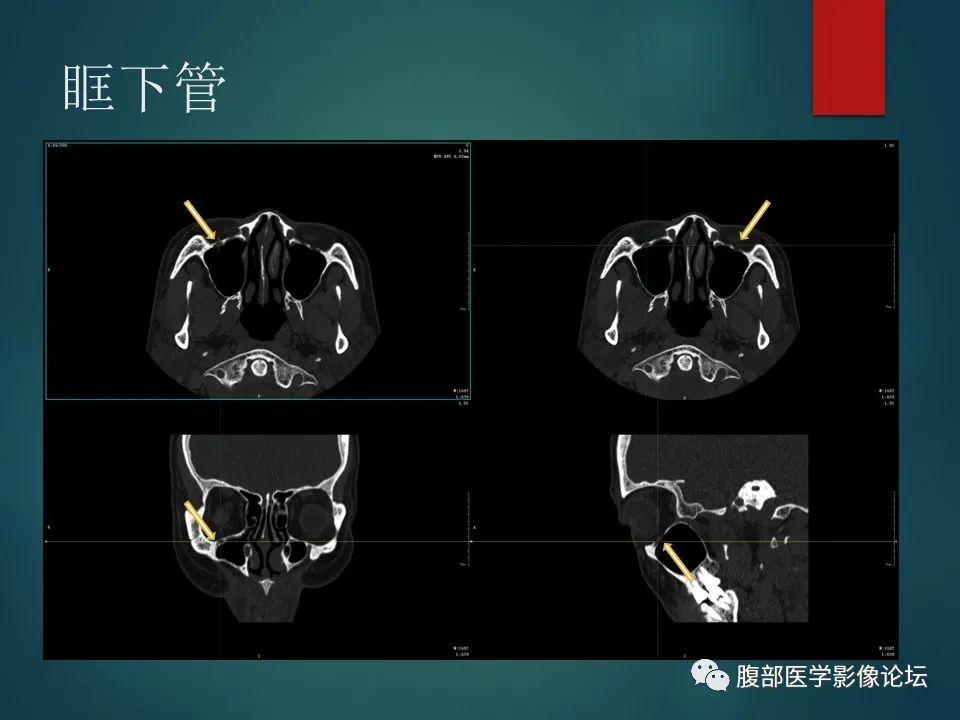 影像PPT - 【PPT】三叉孔道弯弯绕-67 影像PPT - 【PPT】三叉孔道弯弯绕-67