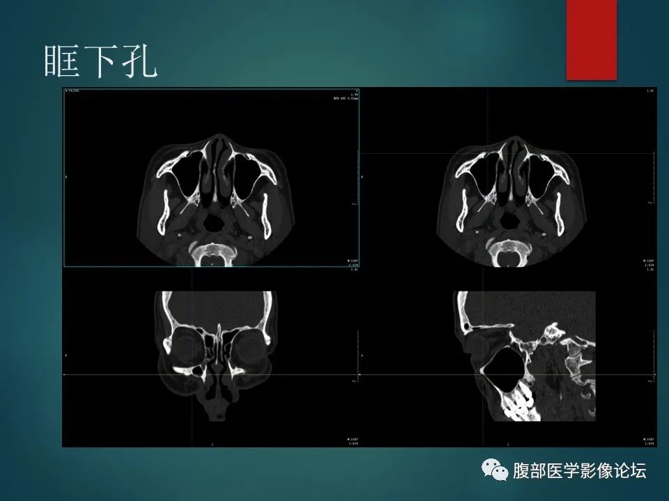 影像PPT - 【PPT】三叉孔道弯弯绕-68 影像PPT - 【PPT】三叉孔道弯弯绕-68