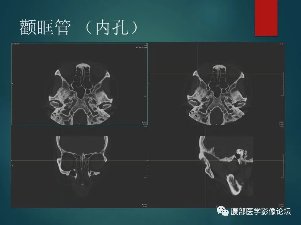 影像PPT - 【PPT】三叉孔道弯弯绕-69 影像PPT - 【PPT】三叉孔道弯弯绕-69
