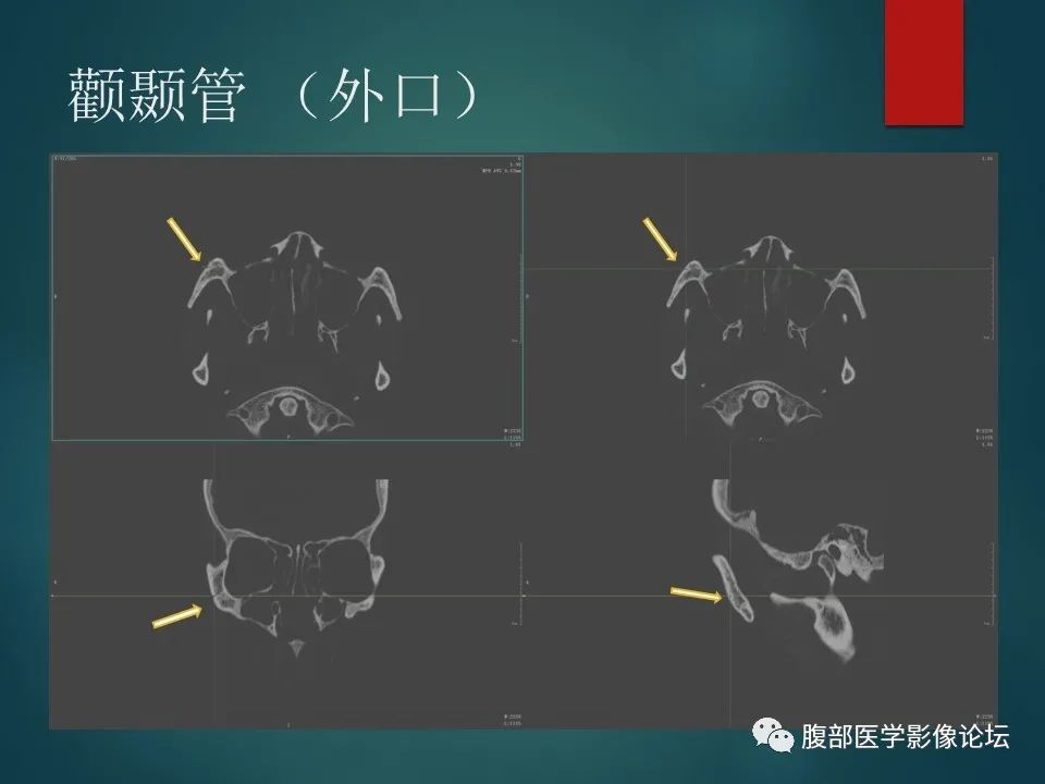 影像PPT - 【PPT】三叉孔道弯弯绕-70 影像PPT - 【PPT】三叉孔道弯弯绕-70