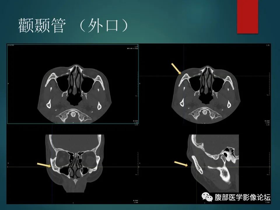 影像PPT - 【PPT】三叉孔道弯弯绕-71 影像PPT - 【PPT】三叉孔道弯弯绕-71
