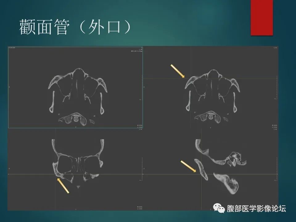 影像PPT - 【PPT】三叉孔道弯弯绕-72 影像PPT - 【PPT】三叉孔道弯弯绕-72