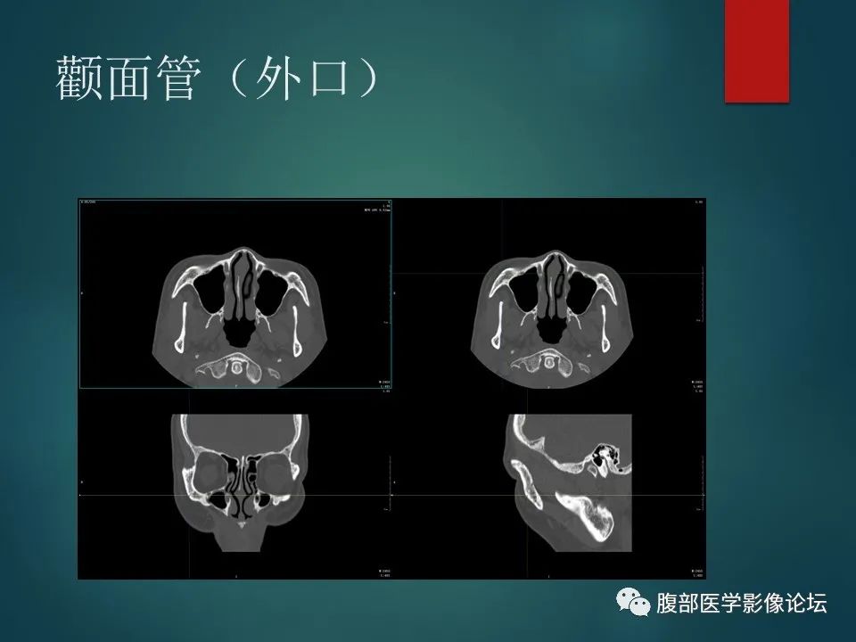 影像PPT - 【PPT】三叉孔道弯弯绕-73 影像PPT - 【PPT】三叉孔道弯弯绕-73