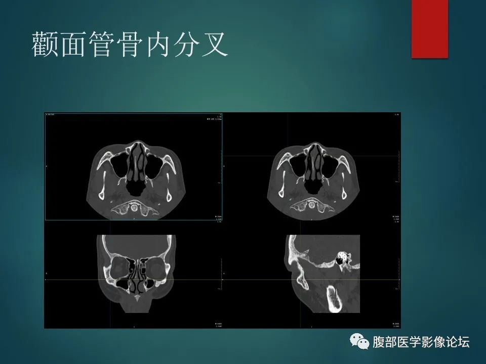 影像PPT - 【PPT】三叉孔道弯弯绕-74 影像PPT - 【PPT】三叉孔道弯弯绕-74