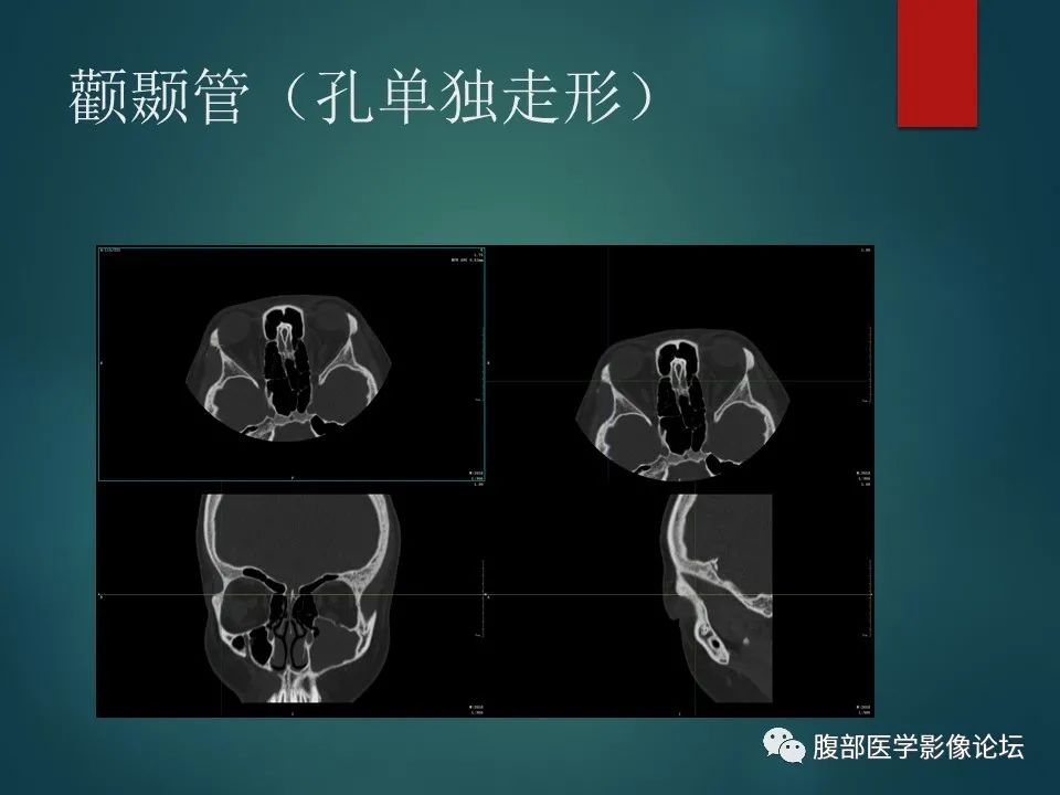 影像PPT - 【PPT】三叉孔道弯弯绕-75 影像PPT - 【PPT】三叉孔道弯弯绕-75