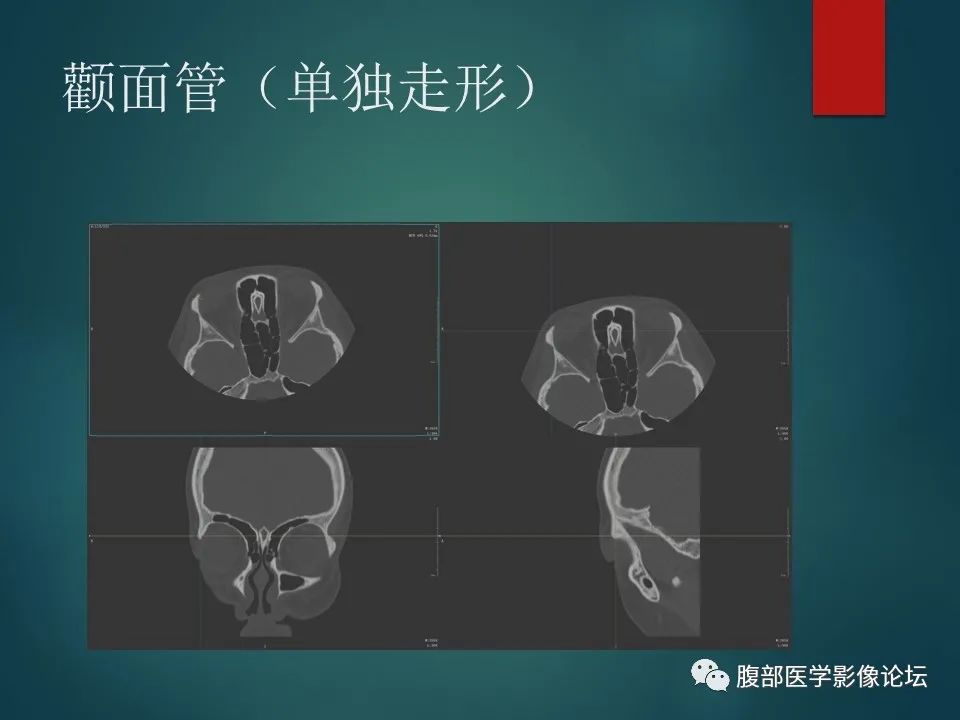 影像PPT - 【PPT】三叉孔道弯弯绕-76 影像PPT - 【PPT】三叉孔道弯弯绕-76