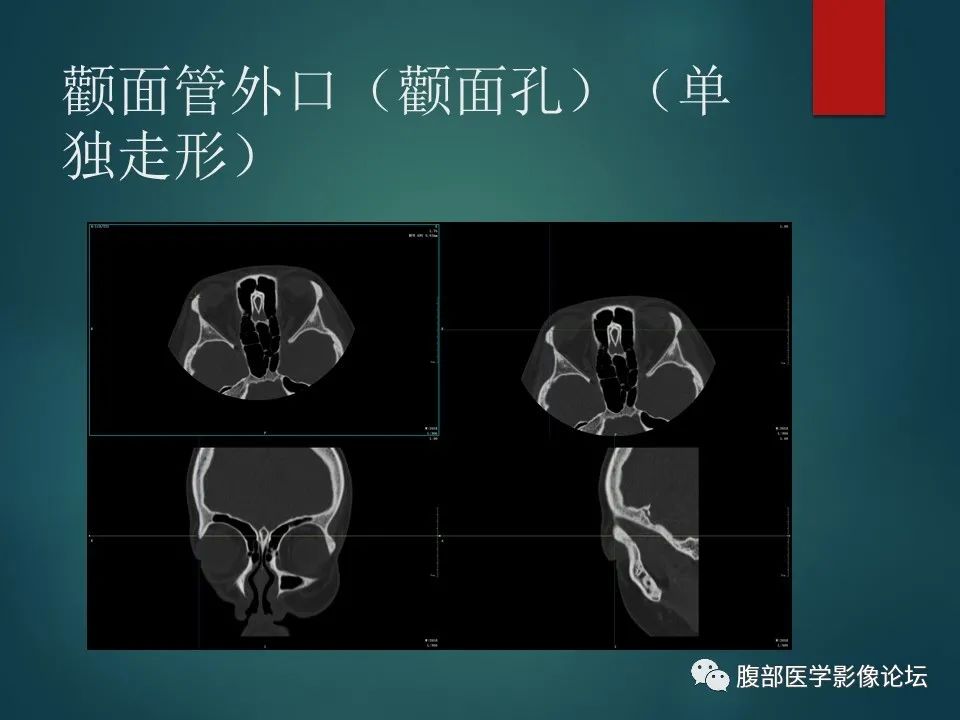 影像PPT - 【PPT】三叉孔道弯弯绕-77 影像PPT - 【PPT】三叉孔道弯弯绕-77