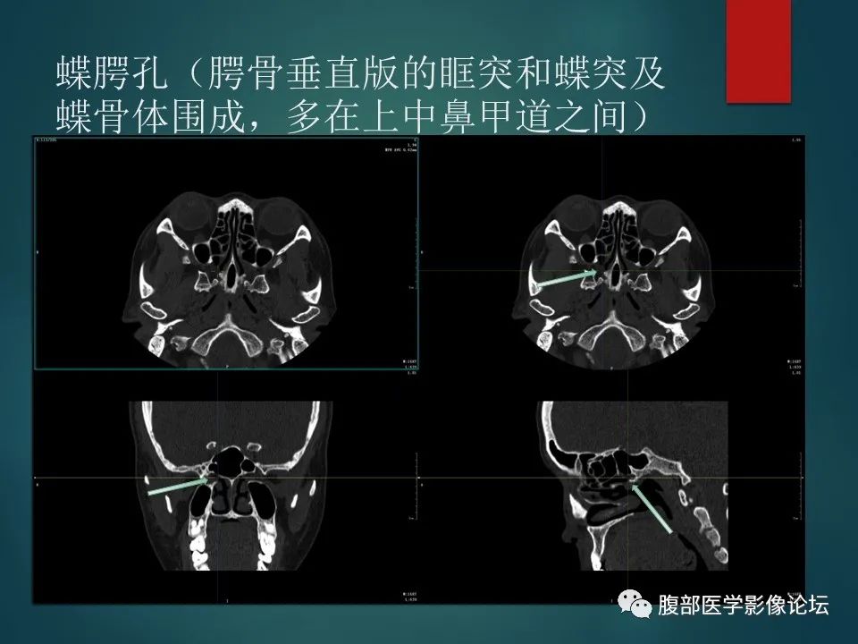影像PPT - 【PPT】三叉孔道弯弯绕-79 影像PPT - 【PPT】三叉孔道弯弯绕-79