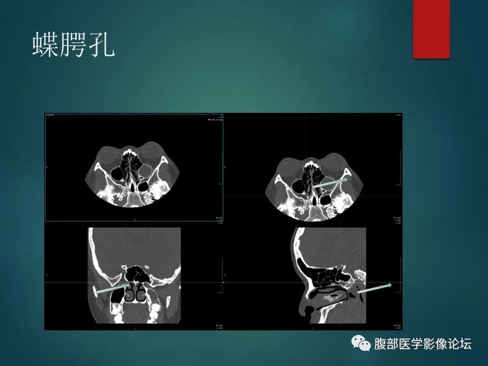 影像PPT - 【PPT】三叉孔道弯弯绕-80 影像PPT - 【PPT】三叉孔道弯弯绕-80